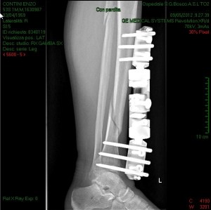 Radiografia con fissatore (9/5/2012)