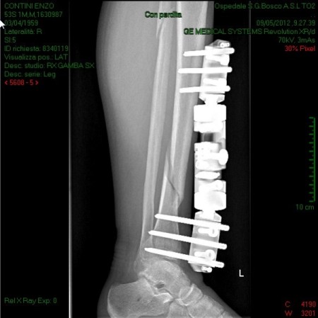 Radiografia con fissatore (9/5/2012)