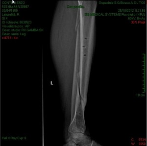 Radiografia con fissatore rimosso (25/10/2012)
