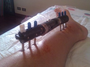 Fissatore durante una medicazione dei chiodi