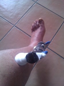 Fissatore con garze sterili per impedire infezioni