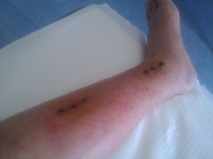 Gamba dopo la rimozione del fissatore e dei relativi chiodi