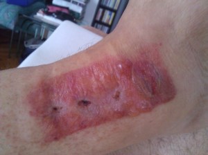 Allergia sviluppata alle garze medicate