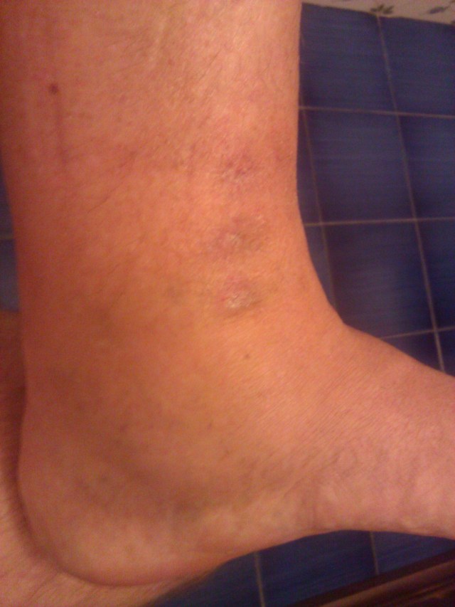 Evidente gonfiore di caviglia e gamba